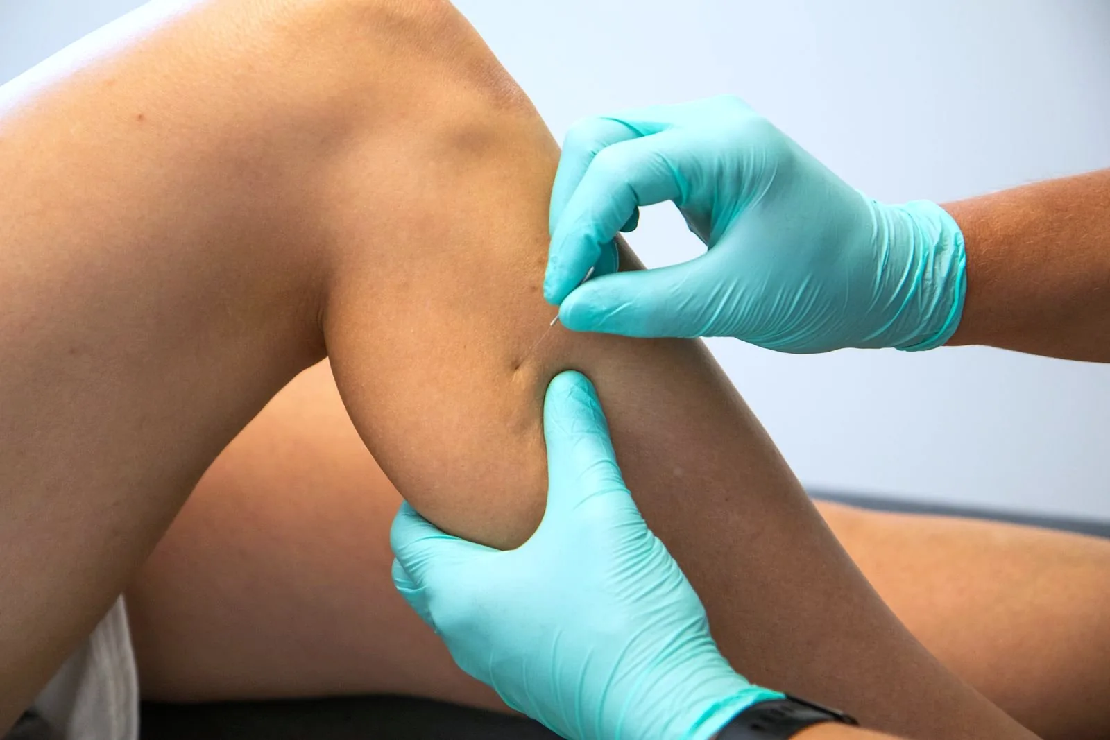 Dry needling bij Praktijk Het Riet